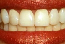 В Росії стоматолог видалила пацієнтці... 22 здорових зуба