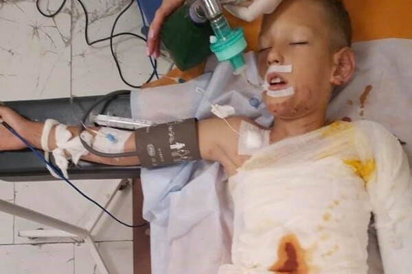 У Дніпрі  8-річного хлопчика облили бензином і підпалили