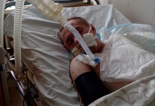 Потрібна допомога 27-річному лучанину, який впав на газову плиту і отримав сильні опіки
