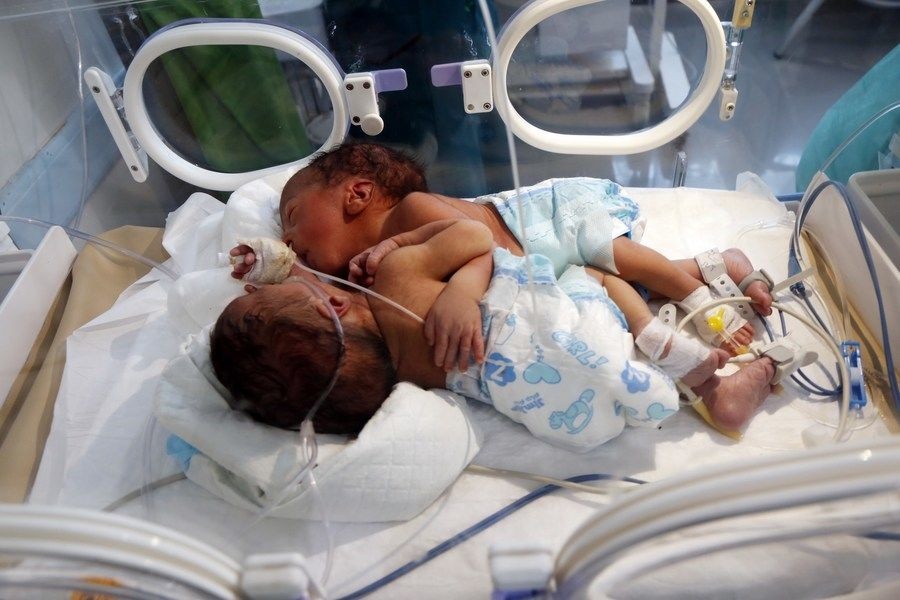 У Ємені народилися сіамські близнюки