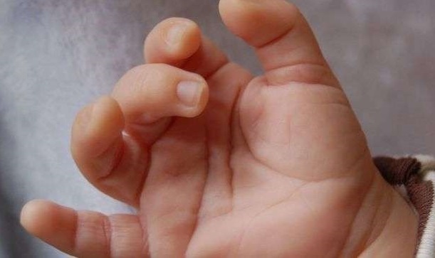 У Чернівцях 3-річній дитині приживили відсічений палець