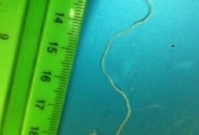 З ока 3-річної дитини лікарі дістали 10-сантиметрового гельмінта