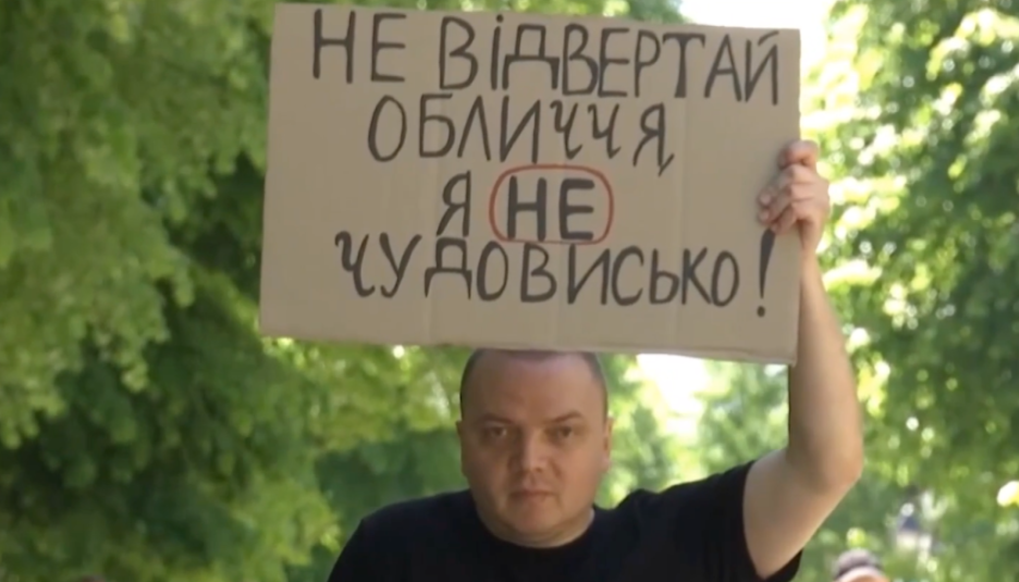 Військовий, який втратив ногу, влаштував акцію у Луцьку: «Не відвертай обличчя, я не чудовисько»