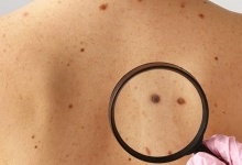 Як вчасно виявити рак шкіри: поради дерматологині