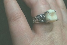 Американка отримала обручку із зубом нареченого замість камінця