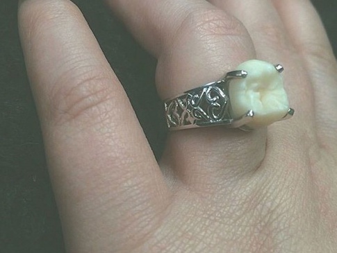 Американка отримала обручку із зубом нареченого замість камінця