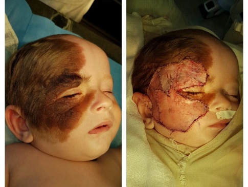 Піврічному малюку зі складною вадою провели операцію, яка тривала п’﻿ять годин