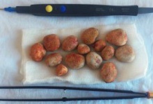 На Волині медики видалили одразу 14 каменів з нирок пацієнта