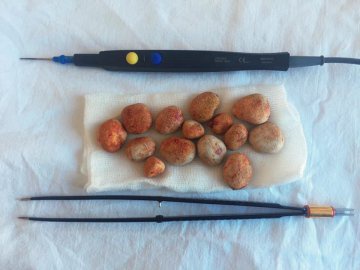 На Волині медики видалили одразу 14 каменів з нирок пацієнта
