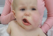 Хірург з Волині прооперував малюка з гігантською ліпомою на обличчі