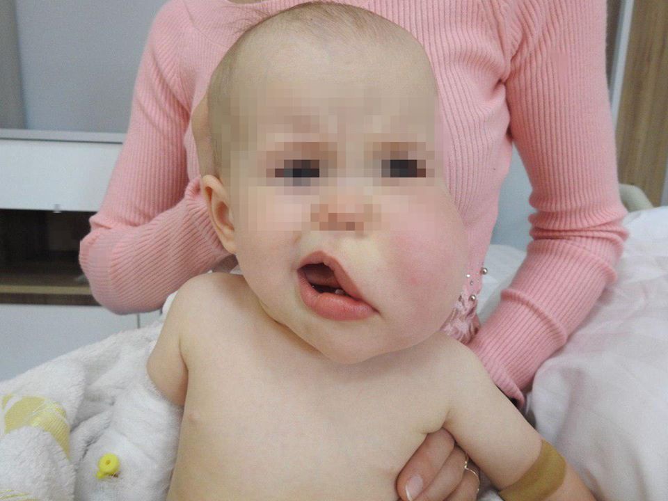 Хірург з Волині прооперував малюка з гігантською ліпомою на обличчі
