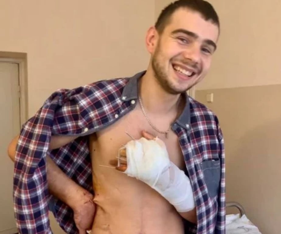 23-річному хлопцю зі Львівщини пришили відірвану бетономішалкою руку