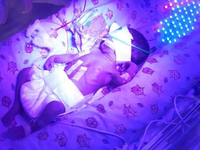 У Луцьку рятують життя народженої на 6 місяці «дюймовочки»