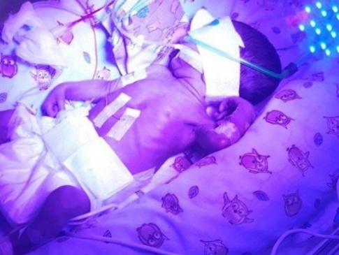 У Луцьку рятують життя народженої на 6 місяці «дюймовочки»