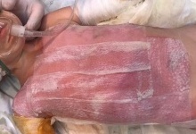 У Запоріжжі рятують життя малюку, який обварився в окропі. ФОТО 18+
