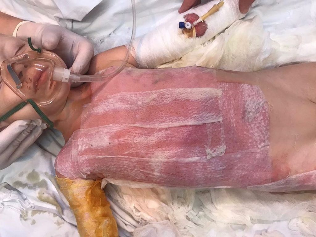 У Запоріжжі рятують життя малюку, який обварився в окропі. ФОТО 18+