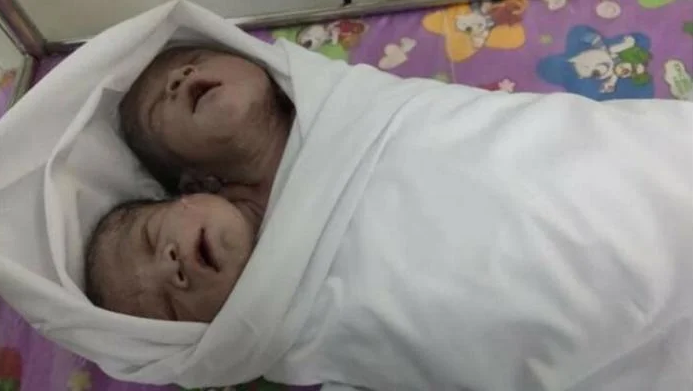 29-річна жінка народила дитину з двома головами