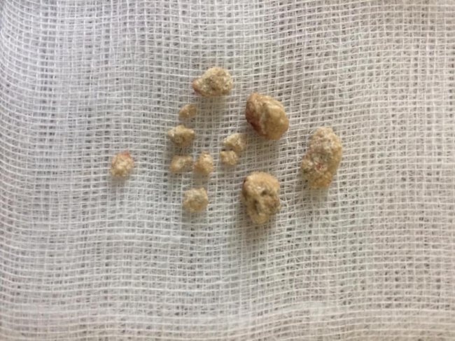 Волинські лікарі видалили великий камінь з нирки через сантиметровий розріз