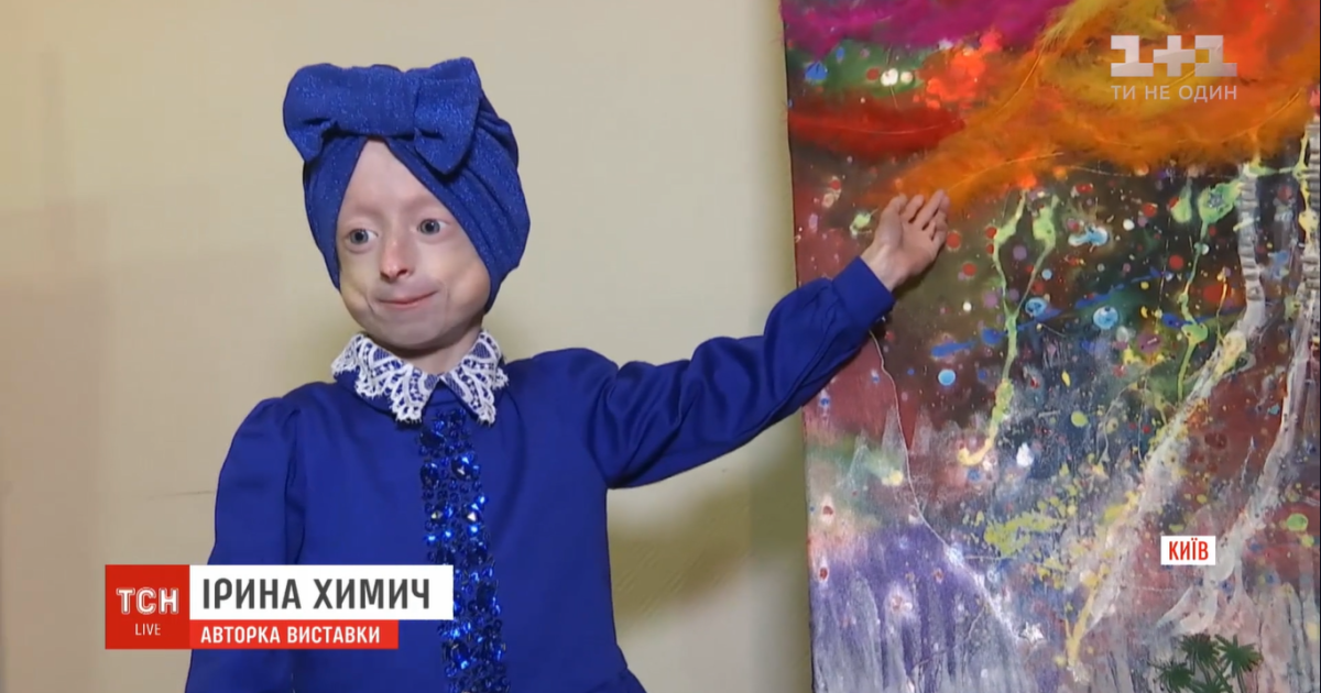 Дитина з тілом 80-річної: в Україні провели унікальну операцію дівчинці з хворобою передчасного старіння