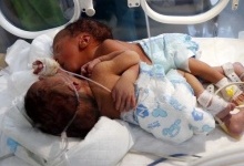 У Ємені народилися сіамські близнюки