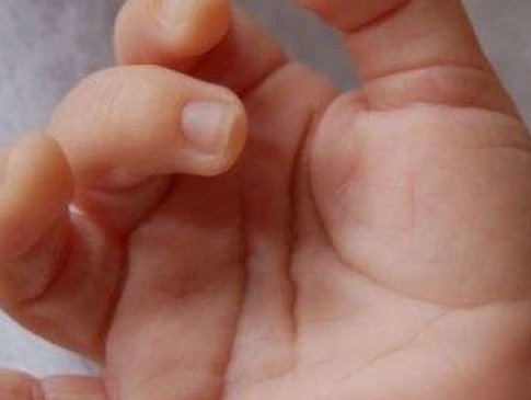 У Чернівцях 3-річній дитині приживили відсічений палець