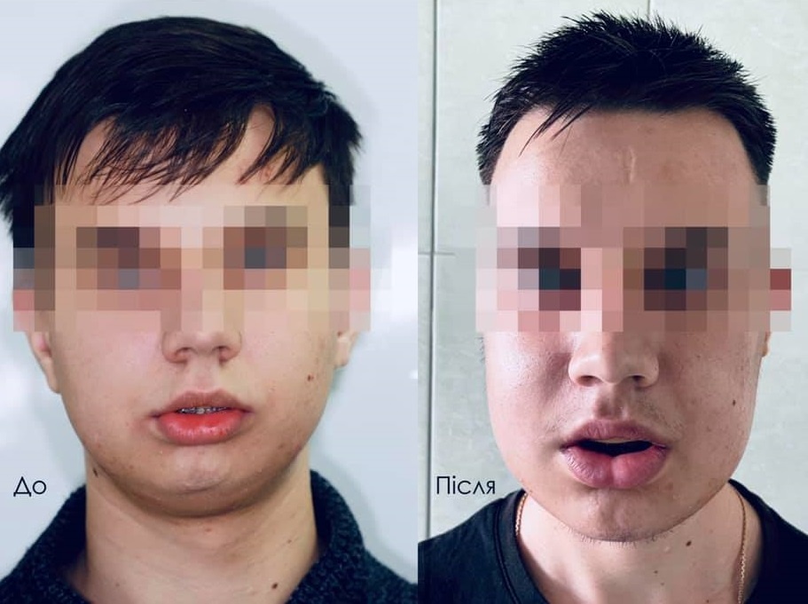 У Львові провели складну операцію із реконструкції обличчя