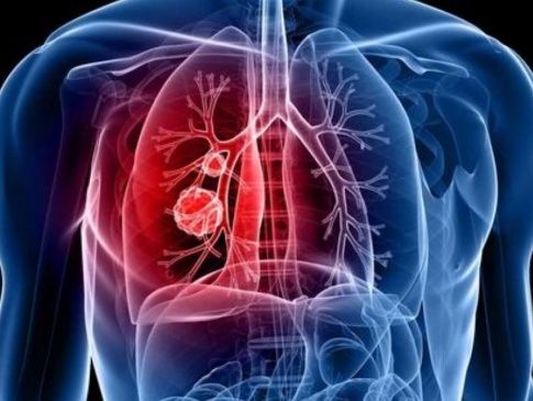 На Волині більше пів тисячі людей захворіли на туберкульоз