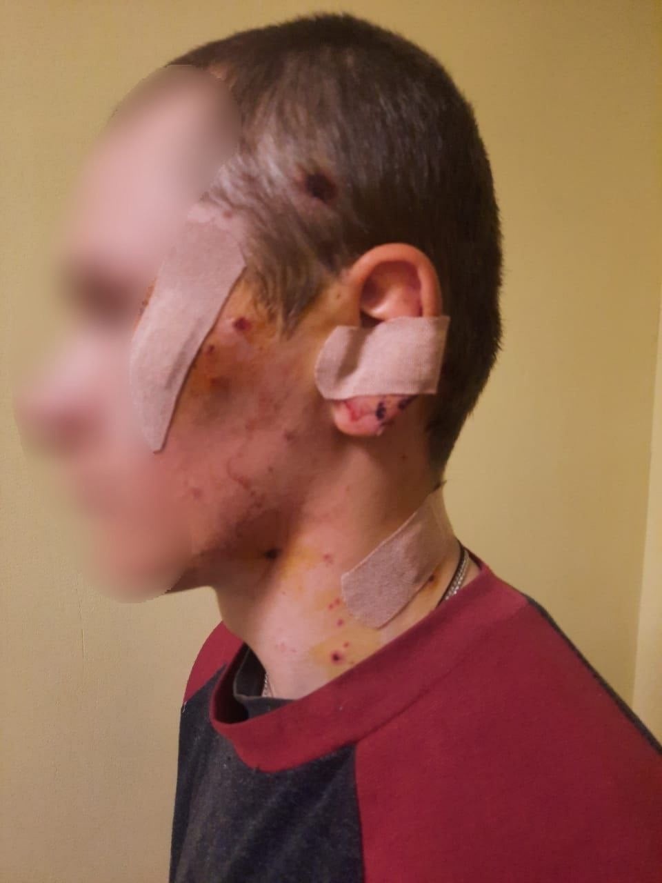 Біля Києва 17-річний хлопець підірвався на розтяжці
