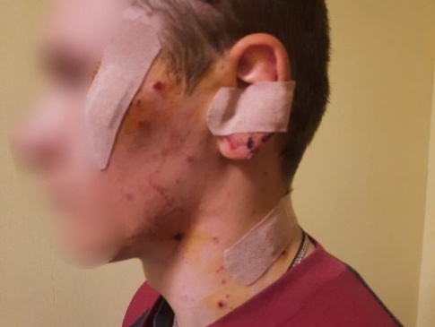 Біля Києва 17-річний хлопець підірвався на розтяжці