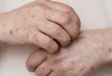 В Україні зареєстроване небезпечне інфекційне захворювання